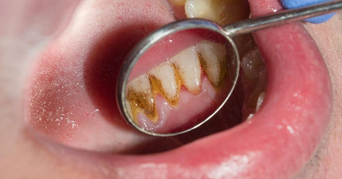 Waspada Ancaman Karang Gigi: Panduan Lengkap Pencegahan Mandiri untuk Senyum Sehat